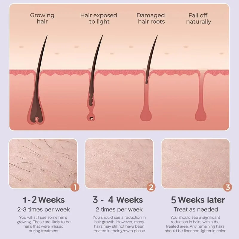 IPL Hair Removal handset portable